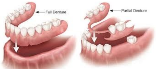 Dentures - full and partial
